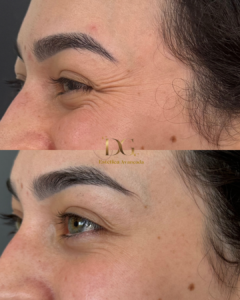 Antes X Depois QUALIDADE DE PELE - Dani Botox