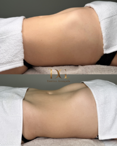 Antes X Depois QUALIDADE DE PELE - Dani Neris- Drenagem