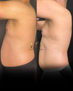 Antes X Depois QUALIDADE DE PELE - Eduardo- Hidrolipo