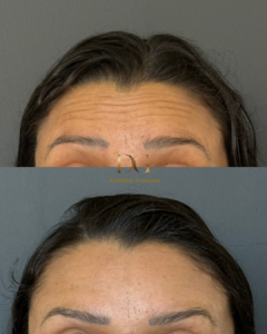 Antes X Depois QUALIDADE DE PELE - Gisa- Botox (1)