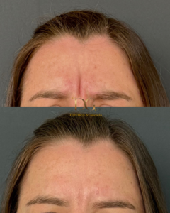 Antes X Depois QUALIDADE DE PELE - Lucia- Botox