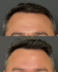Antes X Depois QUALIDADE DE PELE - Marcio- Botox