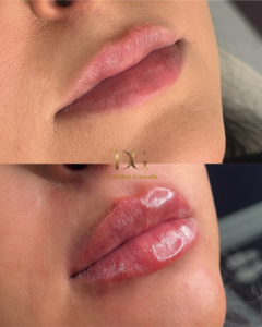 Antes X Depois QUALIDADE DE PELE - Nadia Preeenchimento (1)