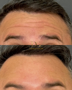 Marcio- Botox
